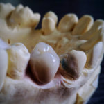 Fotografía publicitaria: Corona dental